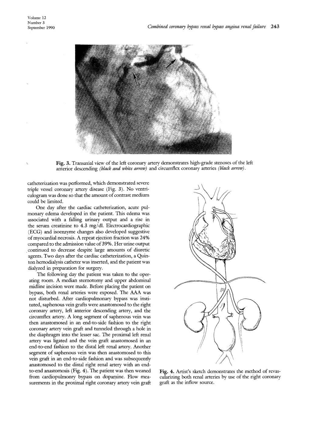 Volume 12 Number 3 September 1990 Combined coronary bypass renal bypass angina renal failure 243 Fig. 3. Transaxial view of the left coronary artery demonstrates high-grade stenoses of the left anterior descending (black and wbi~e arrow) and circumflex coronary arteries (black arrow).