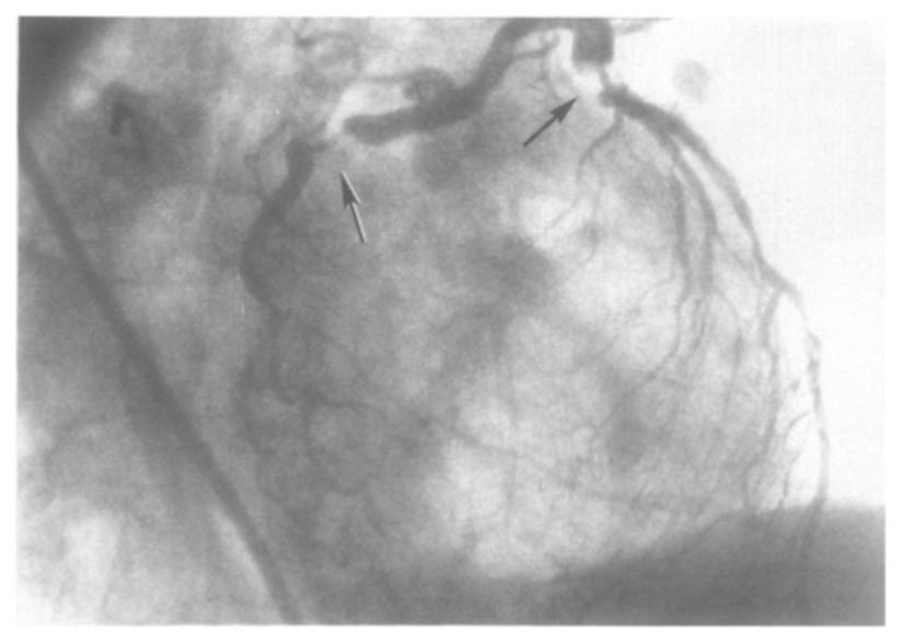 One day after the cardiac catheterization, acute pulmonary edema developed in the patient. This edema was associated with a falling urinary output and a rise in the serum creatinine to 4.3 mg/dl.