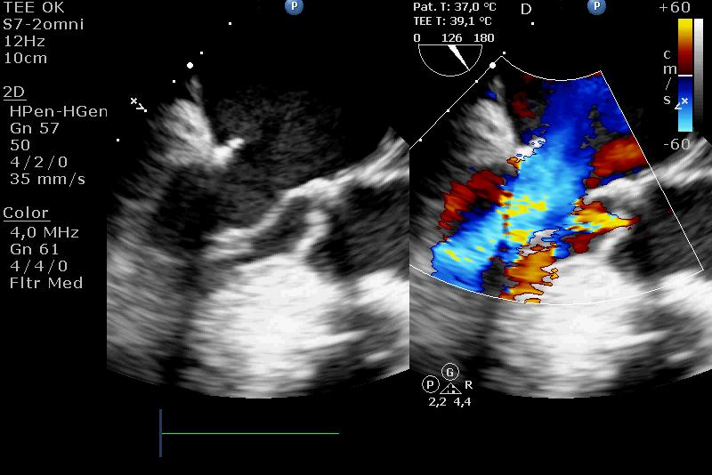 The incidence of SAM and LVOTO were reported to range from 2-16% Displacement of the anterior leaflet of the mitral