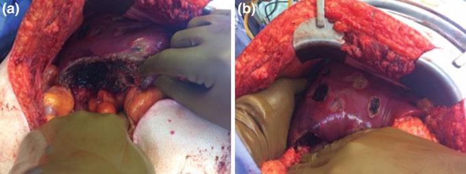 2 Debulking of Extensive Neuroendocrine Liver Metastases 21 Fig. 2.3 Post-treatment photographs of patient with mid-gut NET.