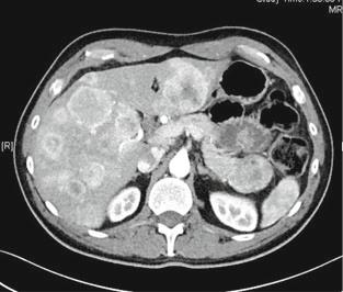 2 Debulking of Extensive Neuroendocrine Liver Metastases 23 Case 2: Pancreas NET Metastatic to Liver The patient is a 52-year-old man who worked at a steel mill and had a back injury.