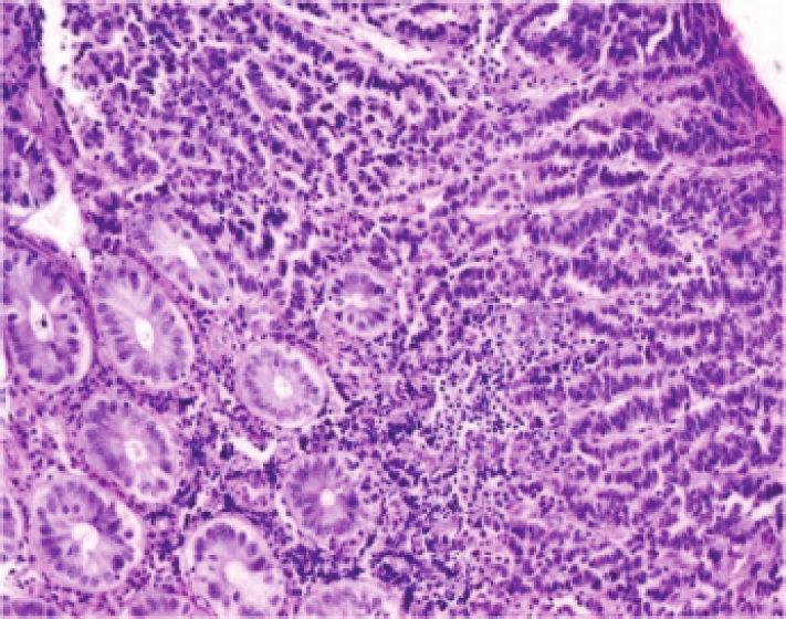 Case Reports in Oncological Medicine Figure 4: Photomicrograph showing neuroendocrine involving the rectum.
