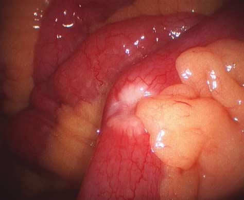 Figure 2. Primary ileal neuroendocrine tumor. Note the tumor is characteristically white and dimples the serosa.