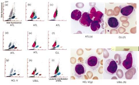 lymphoid leukemias Fig. 6 AML / TLD patient with megathrombocytes.