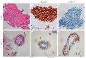 cell morphology Chromogranin/ Synaptophysin/ CD56- SCLC SqCC +++ - P0/CK5