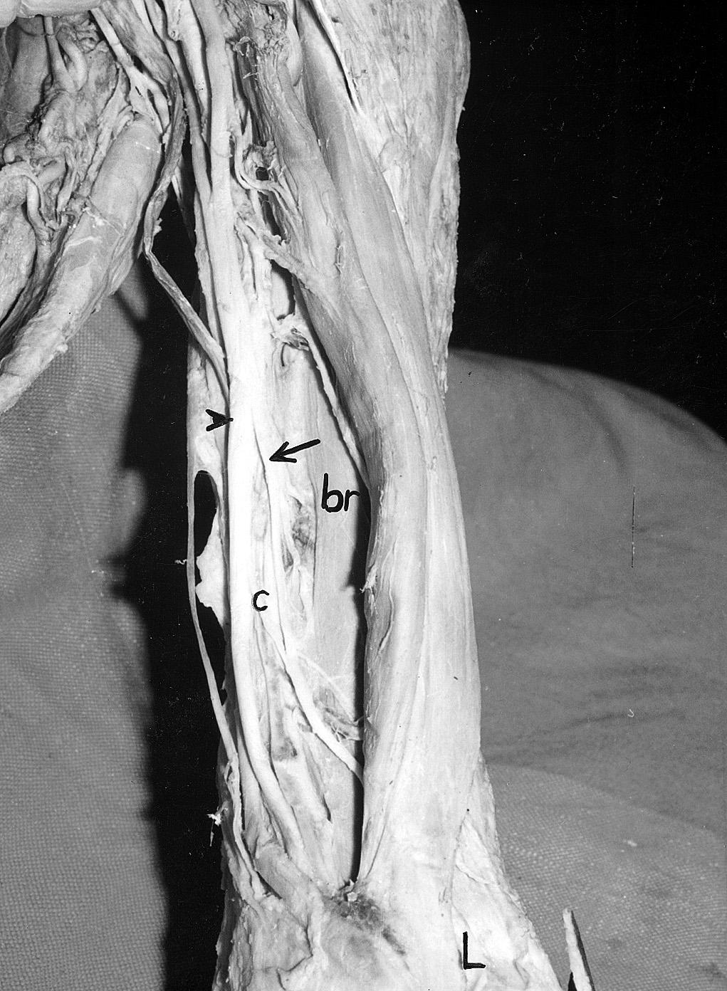 A branch was seen to arise from the lateral root of the median nerve at 1.5 cm above the point of union of the two roots of the median nerve and 10 cm distal to the acromion.