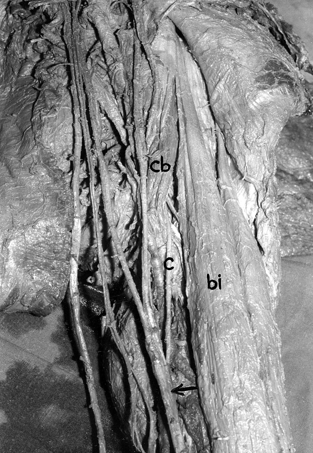A photograph of the left axilla and arm regions of an adult human cadaver showing a communicating branch (c) between the median (arrow) and the musculocutaneous nerves.