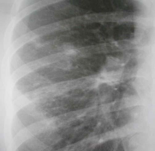 Before Initiating Treatment for LTBI Rule out active TB CXR on everyone sputum collection if the CXR is abnormal or the person is symptomatic Determine prior history of treatment for LTBI or TB