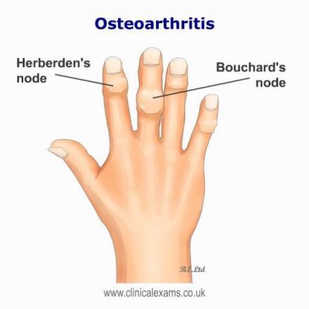 Osteoarthritis ( OA) Osteoarthritis is a chronic disease and the most common of all rheumatological disorders. It particularly affects individuals over the age of 65 years.