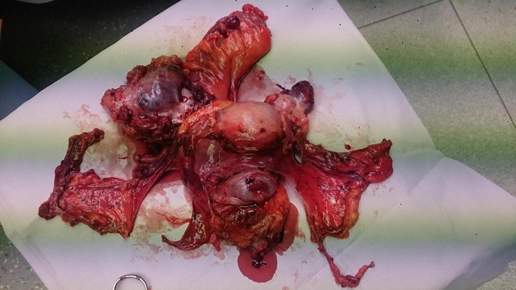 Pelvic exenteration with