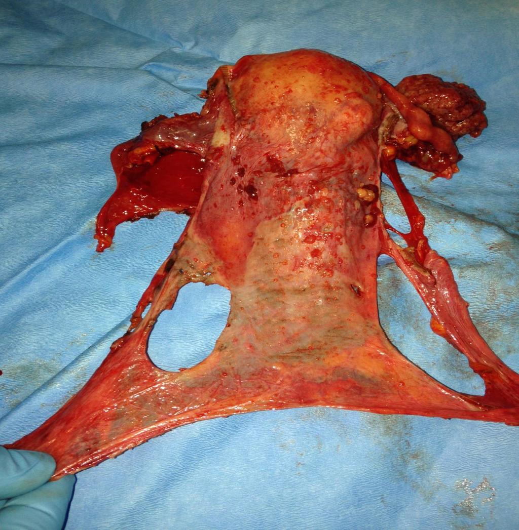 Hysterectomy with double adnexectomy and
