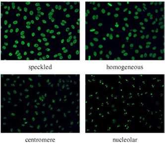 The Anti-nuclear Antigen Can be either ELISA or immunofluorescence based Most commercial labs do ELISA, unless specifically ordered IF gives a pattern,