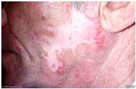 Lupus and The Skin Of the 11 classification criteria for SLE from ACR guidelines, four are skin related.
