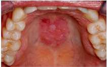 The differential for malar rash and oral ulcers is large. Lupus oral ulcers are usually painless, as opposed to herpes lesions.