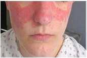 lupus. Always rule out medication causes, as drug induced lupus typically has skin manifestations.
