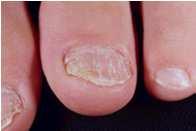 Psoriasis Psoriasis precedes arthritis by average 8-10 years in 67% Arthritis and psoriasis occur together in 33% Check the nails, umbilicus,