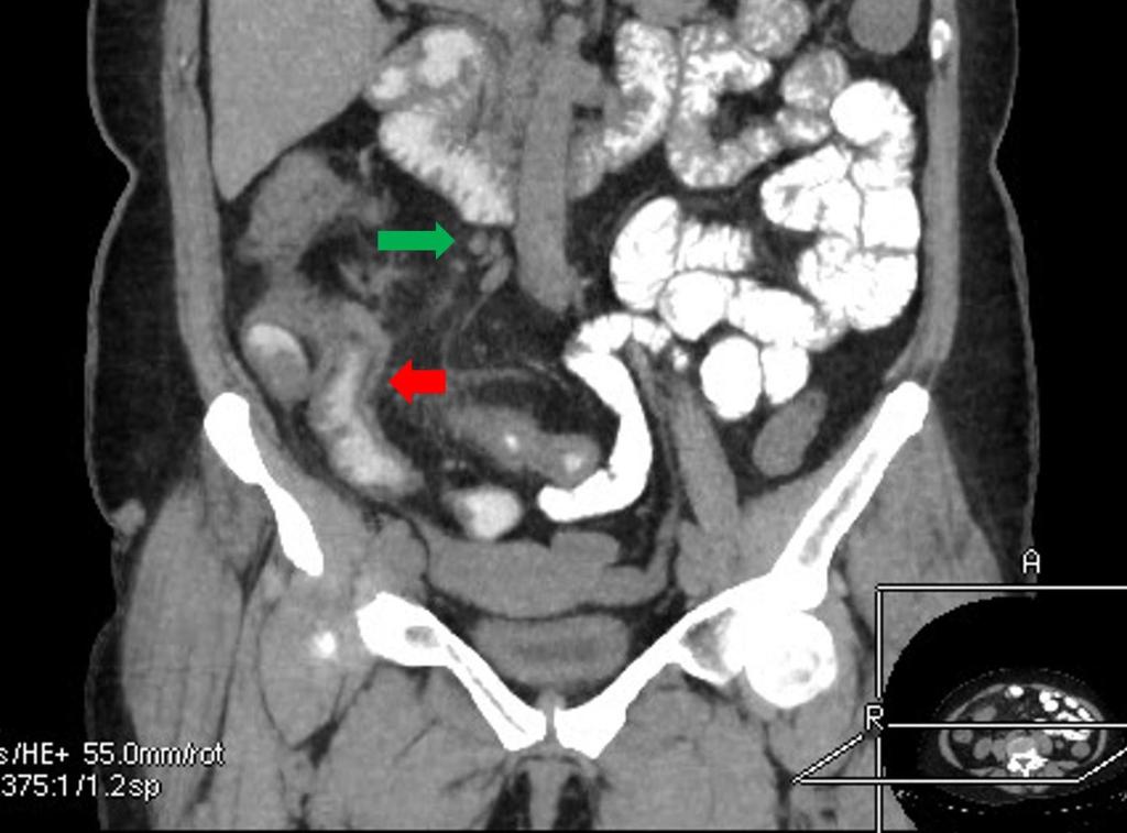 Fig. 10: Non-obstructive short segment intussusception. Axial and sagittal images show bowel within bowel (small green arrows). Fig.