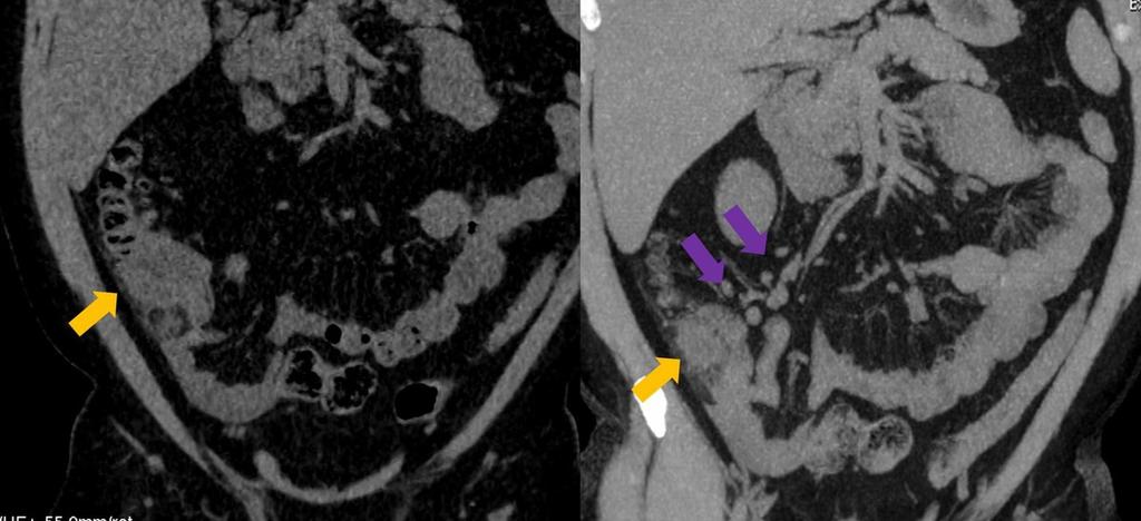 Fig. 12: Coronal MDCT images show segmented caecal wall thickening