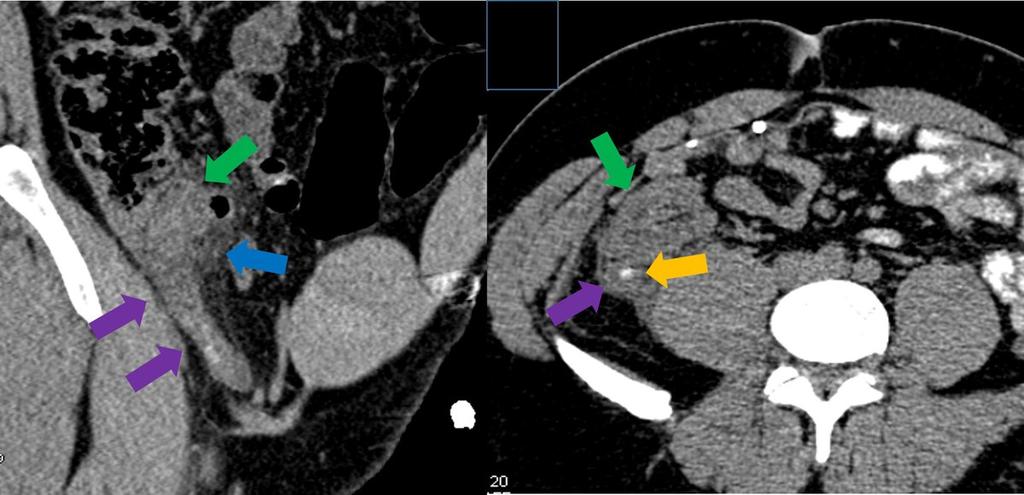 Fig. 4: Coronal oblique and axial CT images show the enlarged appendix with its wall thickening (purple arrows), an appendicolith in the
