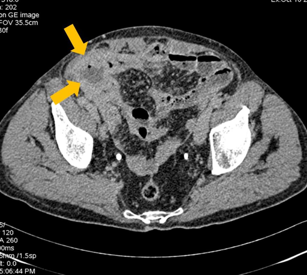 Fig. 7: Perforated appendicitis with periappendiceal abscess.