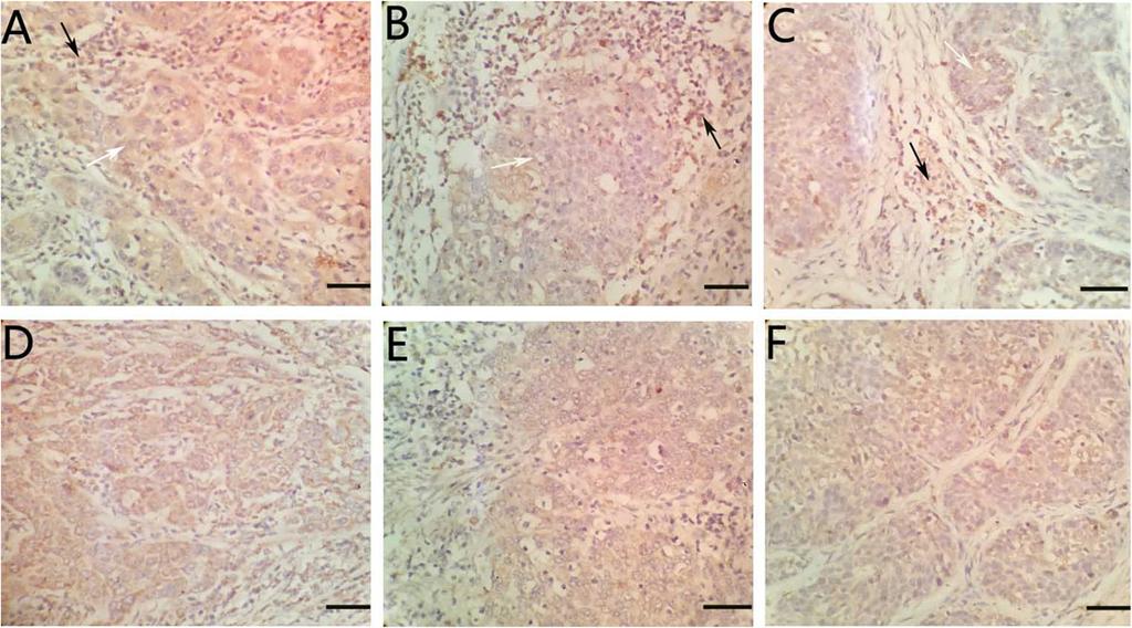Tang et al. World Journal of Surgical Oncology (2017) 15:173 Page 3 of 5 Fig. 1 Immunohistochemical staining of Foxp3 and VEGF-C in cervical cancer tissues.