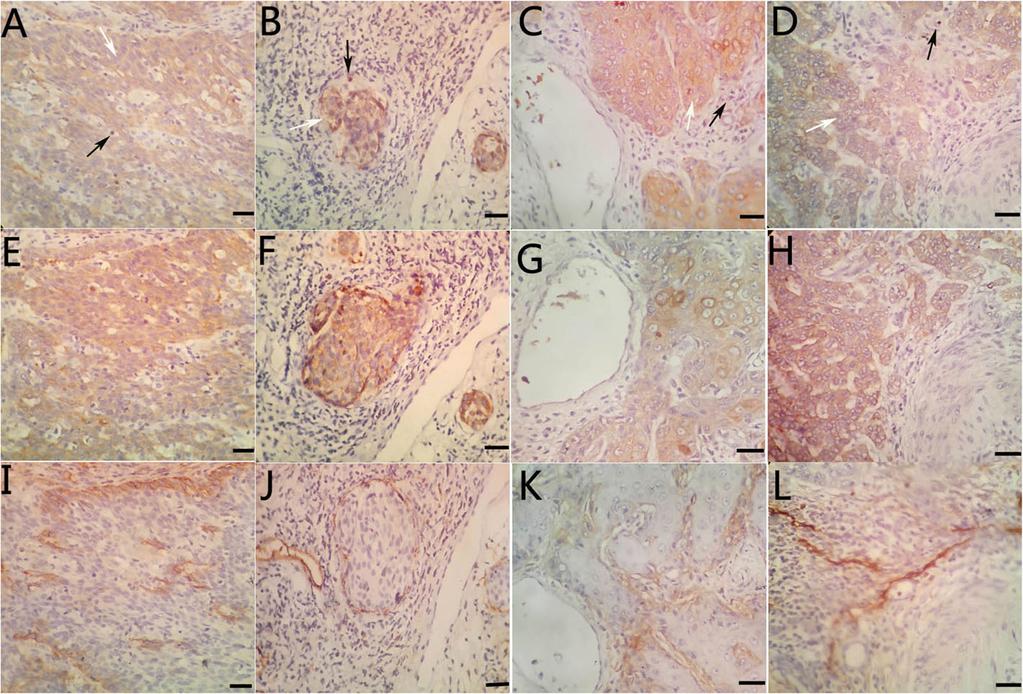 d f Positive VEGF-C expression in cervical cancer ( 100, scale bar 50 μm) lymph node metastasis, and the positive rate was significantly higher than the samples with the absence of lymph node
