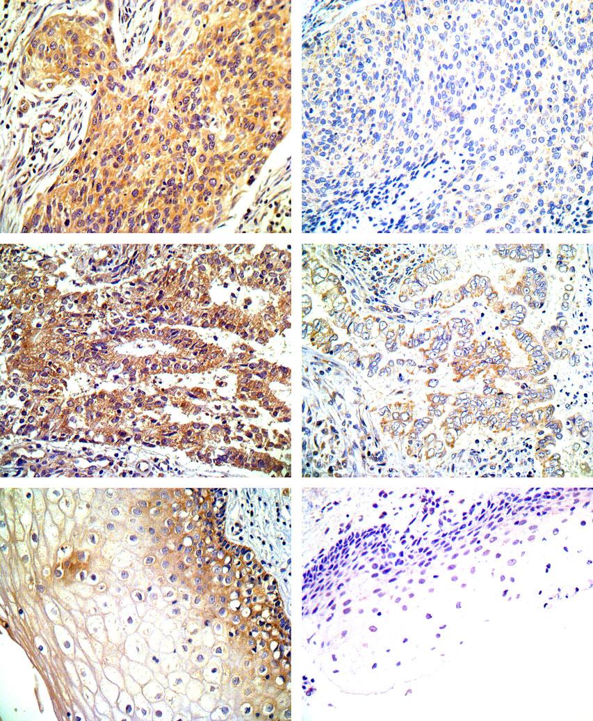 The role of EIF5A2 in early-stage cervical cancer 5 A B C D Figure 3. Representative photomicrographs of eukaryotic initiation factor (EIF)5A2 immunohistochemical staining.