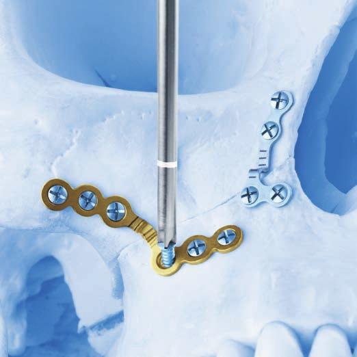 LeFort I Fixation 4 Fixate plate to bone Insert proper length 1.85 mm MatrixORTHOGNATHIC Screws to fixate the plate to the underlying bone. If pilot hole is desired, select the appropriate 1.