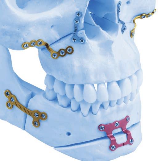 MatrixORTHOGNATHIC TM PLATING SYSTEM Specialized implants and instruments for orthognathic surgery INTRODUCTION The aim of surgical fracture treatment is to reconstruct the bony anatomy and restore