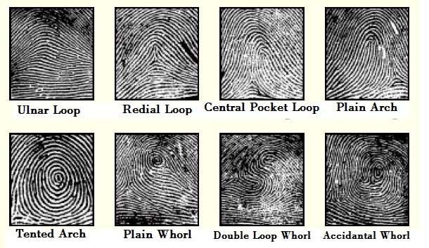 Keywords: Dermatoglyphics; malocclusion; genetic disorder; finger prints. 1. INTRODUCTION Dermatoglyphics is the art and science of studying the patterns of fingerprints.