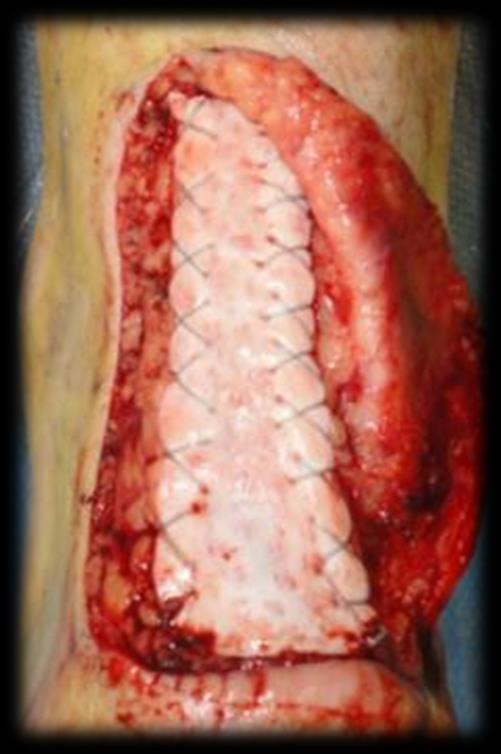 Biomechanical testing has shown allogenic and porcine dermis to be the strongest soft tissue repair matrices,