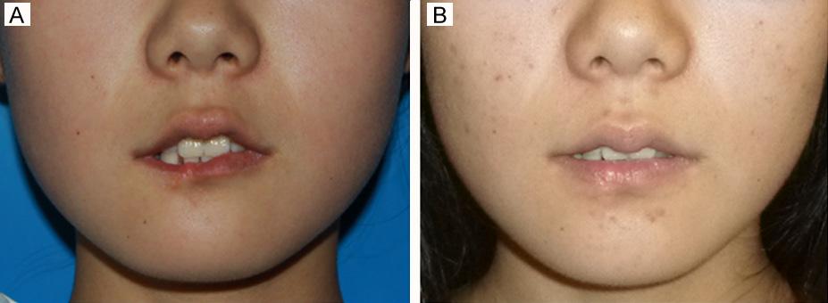 Figure 2. A 19-year-old female patient was given bleomycin A5 intralesional injections in her youth. A. The preoperative positive view shows the right lower lip atrophy. B.