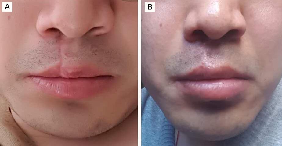 The preoperative positive view of a 30-year-old male patient whose right upper lip lacks volume and has a subunit deficiency because of cleft lip. B.