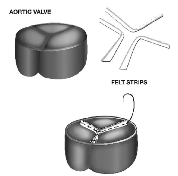 Types of Aortic Valve Procedures Suture Repairs: