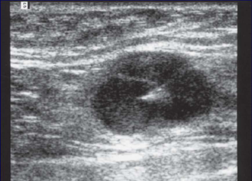 Initial Nodal Ultrasound