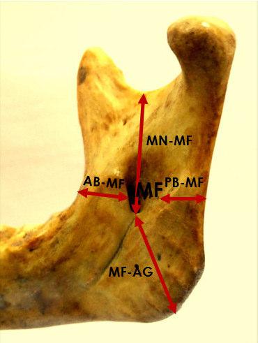 Position of mandibular foramen from various mandibular landmarks Figure 1 Picture showing measurements of mandibular foramen (MF) from various mandibular landmarks like, a) anterior boarder of ramus