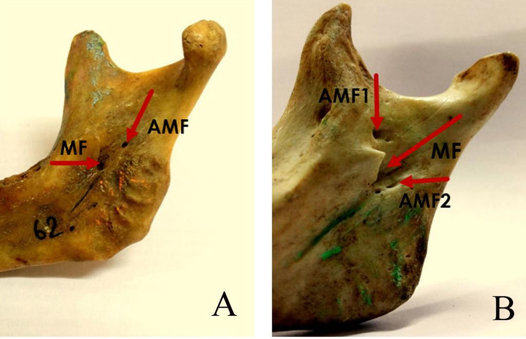 Accessory mandibular foramen Int J Pharm Bio Sci 2015 Jan; 6(1): (B) 282-288 Figure 2 A.Picture showing mandibular foramen (MF) and a single accessory mandibular foramen (AMF). B. Picture showing mandibular foramen and multiple accessory mandibular foramina (AMF1, AMF2).