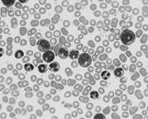 hepatomegaly Reactive Leukocytosis Neutrophilia bacterial infections leukemoid reaction if count > 50,000