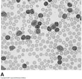 Lymphocytic Leukemia CLL B cells