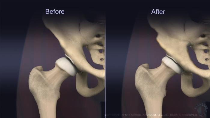 Results Follow up X-rays typically show improvement in the joint orientation and a decrease in contact pressures along the acetabulum.