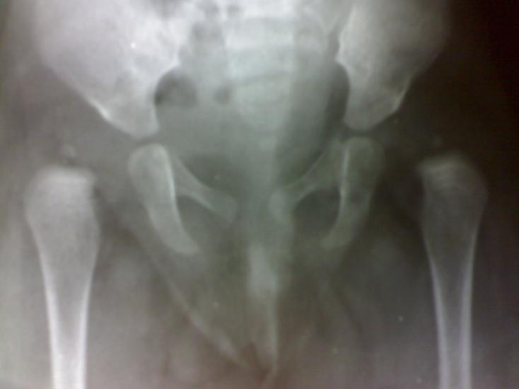 Fig: (2) anteroposterior view of the pelvis for female infant (6 months). Clear evidence of bilateral hip dislocation.