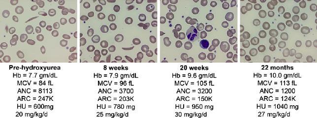 Changes in blood film morphology before and after hydroxycarbamide
