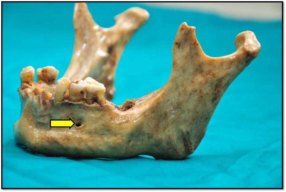 passing between first and second molar Fig. 1: Relation of mental foramen to the body of mandible. Fig. 4: Variable relations of mental foramen to lower teeth (M-molars, PM-premolars, C-canine).