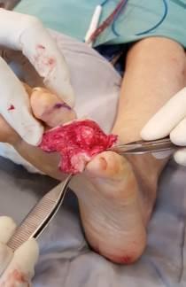 wound complications and