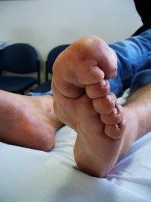 CLINICAL CASE EXAMPLE 1 A 38 year old male patient, with a disproportionate increase in the size of the left hallux.