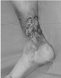 Ulceration Trauma to legs that are compromised Fail orderly healing process Medial Malleolus most common Lateral Tibial Calf Irregular borders with flat wound bed Wound bed friable congested Pain