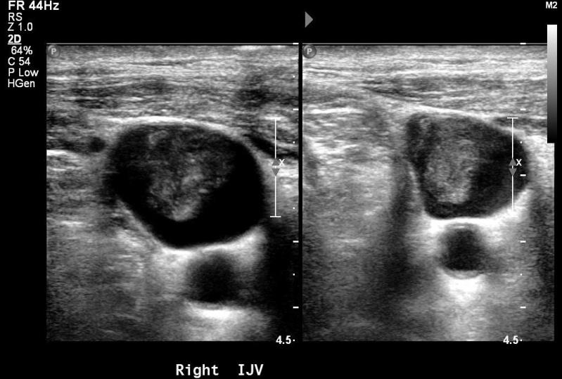 Take Home Points: Acute vs. Chronic DVT in the Vascular Lab In many cases timing of symptoms and classic ultrasound findings make diagnosis of acute DVT vs.