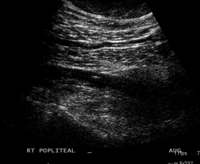 Follow-up on my golfer with leg pain I tracked down the outside hospital images Ultrasound read as