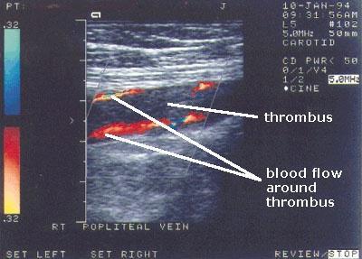 Venous Ultrasound A subtotal occlusive thrombus in the