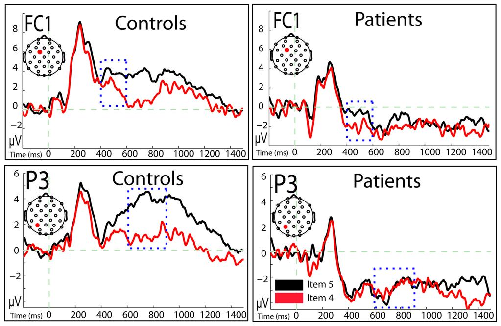 Addante et al. Page 22 Figure 4. ERPs of Item Recognition Confidence for Patients (N=3) and Controls (N=6) (Top panel) FN400 effects at mid-frontal electrode (Fc1).